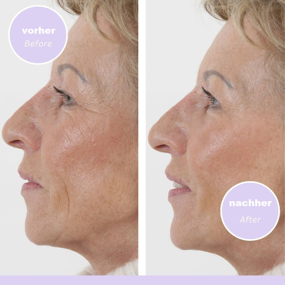 Straffender Faltenfüller "Anti-Wrinkle-Serum"